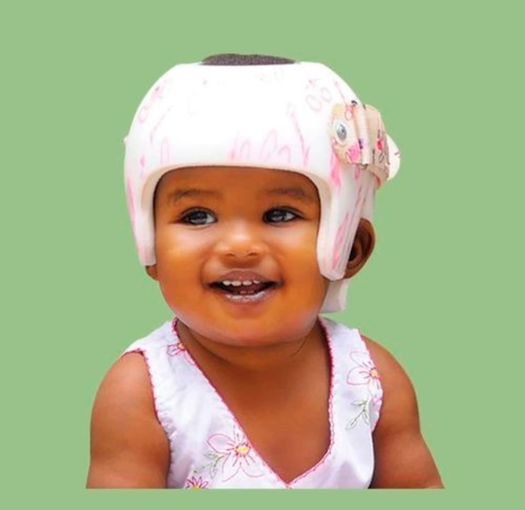 Imagem ilustrativa de um bebê com uma órtese craniana